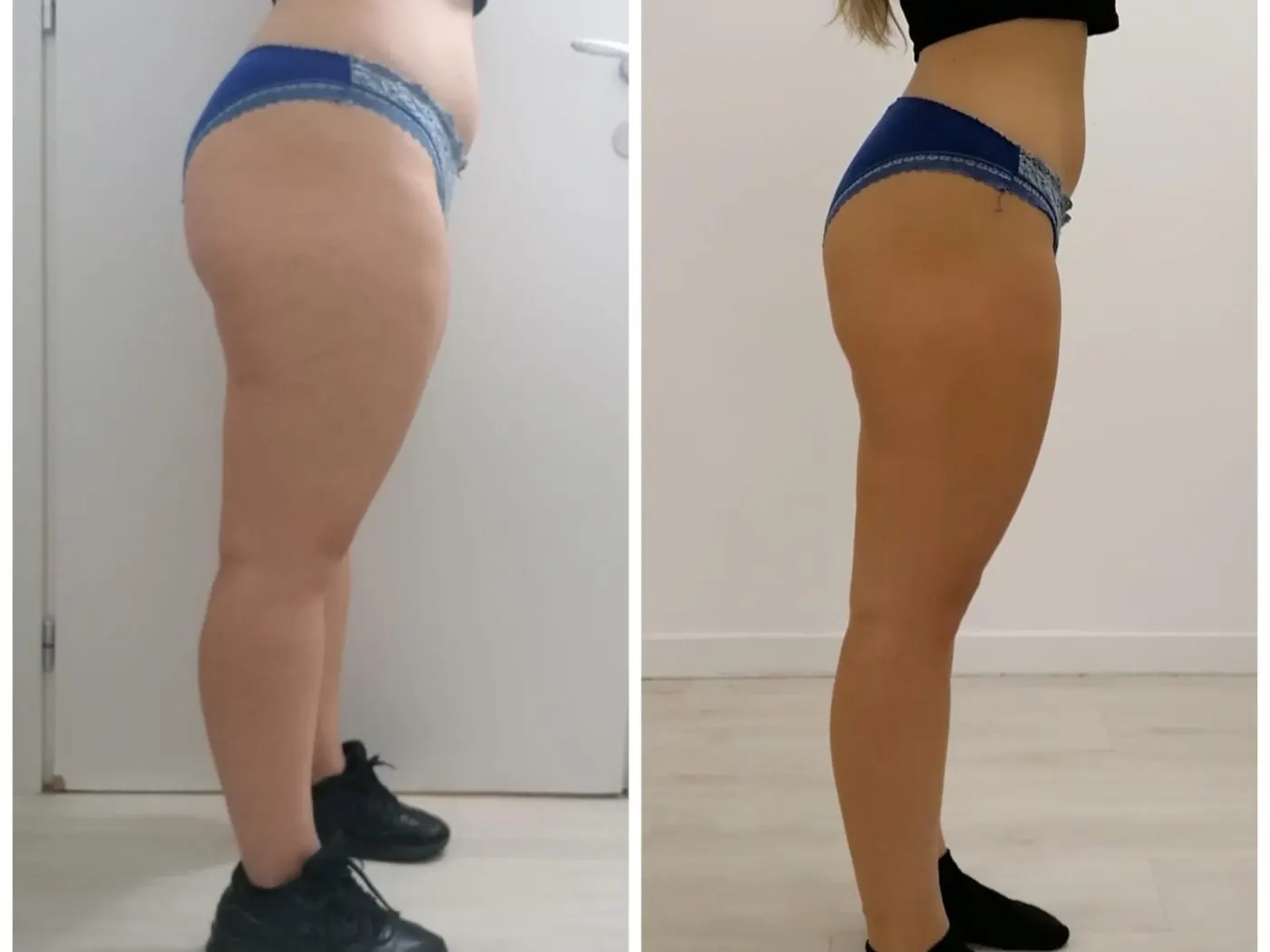 Before and after T-Shape 2: cellulite on the thigh and glute, after 3 treatments