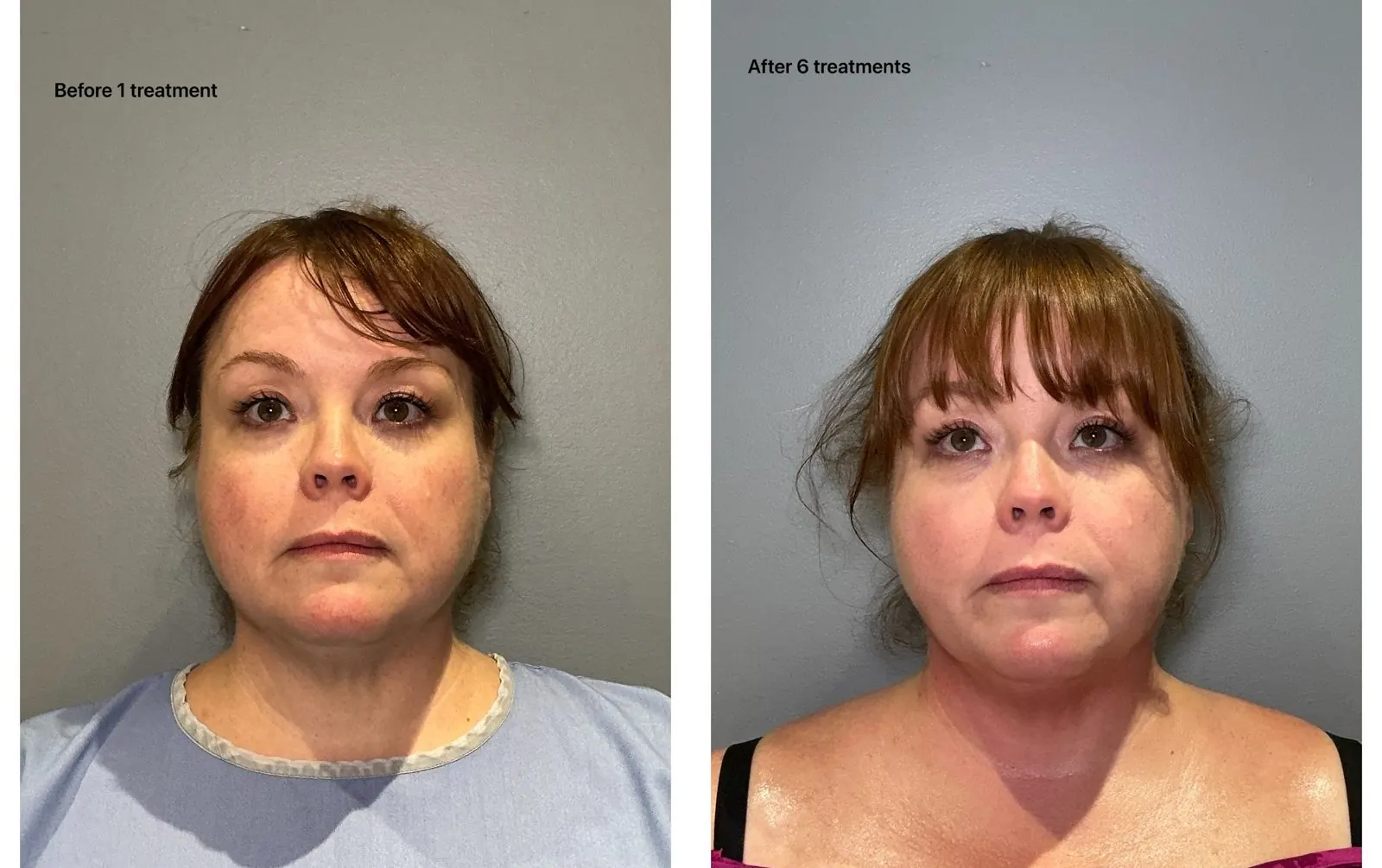 Before and after T-Shape 2: face and jawline, after 6 treatments