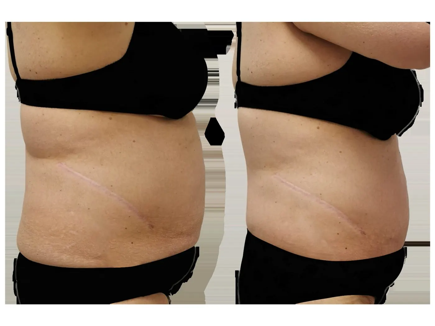 Before and after T-Shape 2: stomach in profile, after 10 treatments