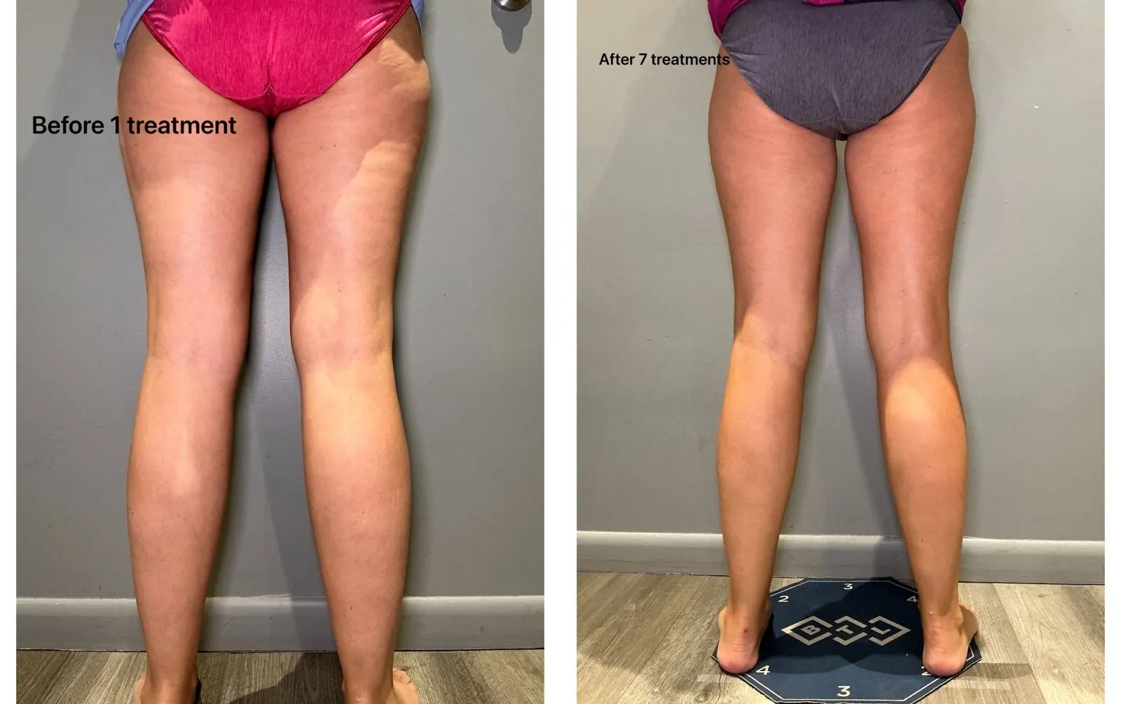 Before and after T-Shape 2: back of thighs, after 7 treatments